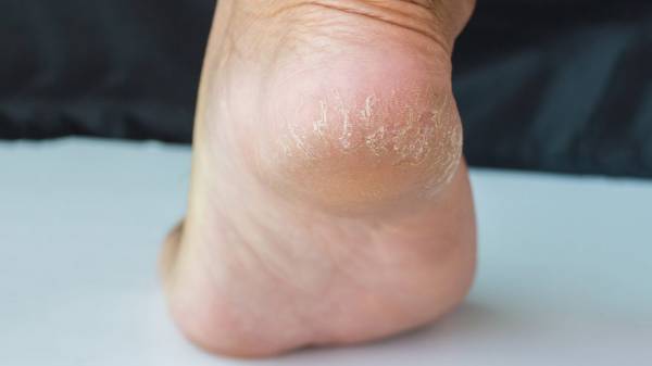 Nguyên nhân khiến gót chân bị tróc da và 7 tips giúp hồi sinh da chân mềm mại