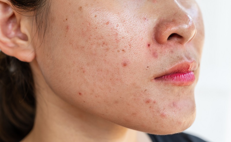4531-cac-buoc-skincare-da-dau-mun-5
