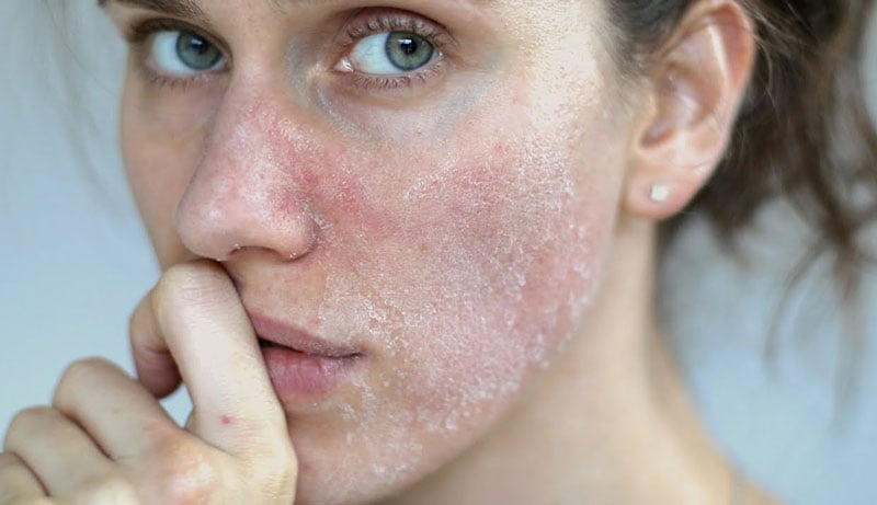 4 kiểu tổn thương da thường gặp phải và cách khắc phục đơn giản
