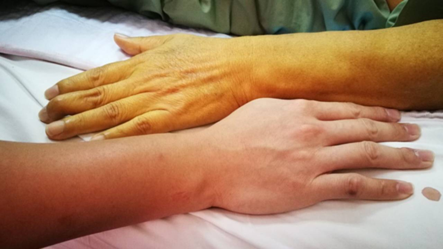 Theo một nghiên cứu tại Ai Cập vào năm 2010, 68% bệnh nhân mắc bệnh gan có những thay đổi bất thường ở móng tay.