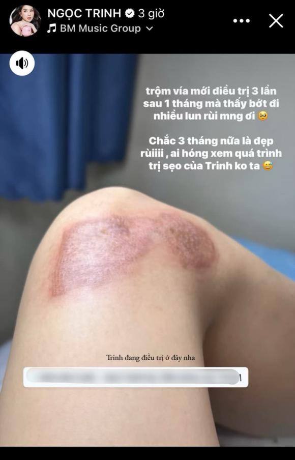 Ngọc Trinh cập nhật tình hình vết thương sau tai nạn xe mô tô
