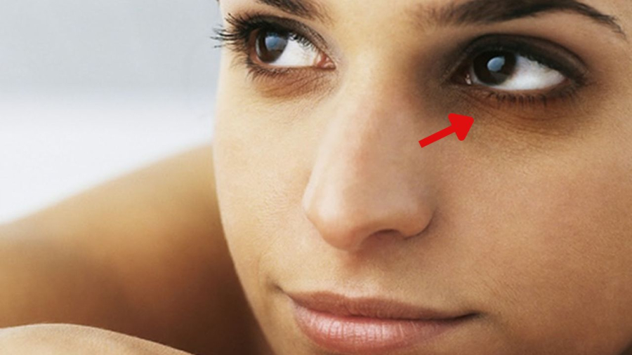 Thâm quầng mắt không chỉ là do thiếu ngủ mà có thể do thiếu một số vitamin