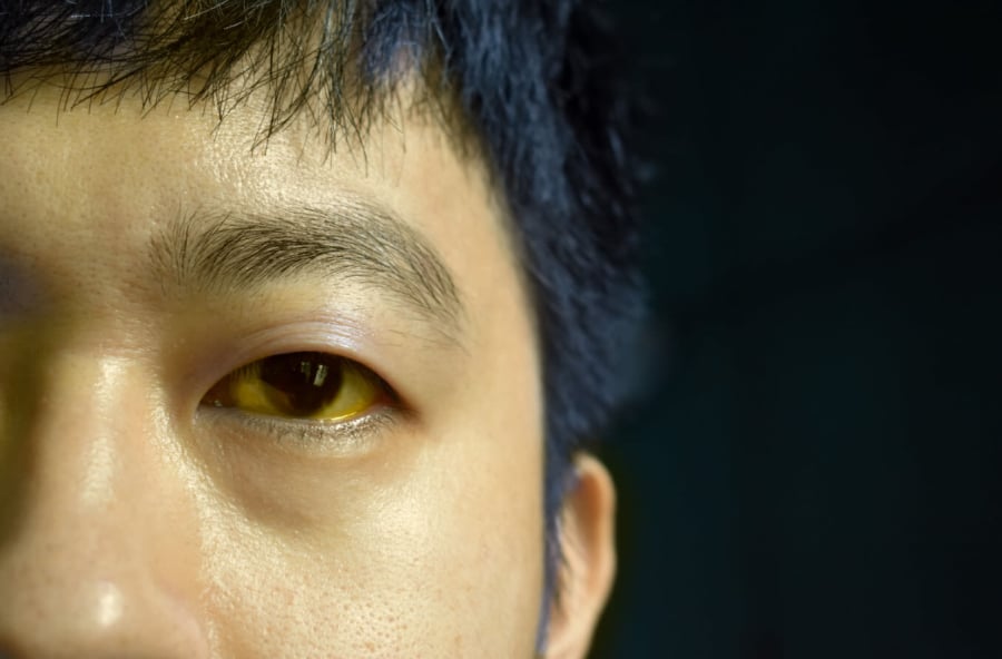 Mắt màu vàng thường là dấu hiệu của sự suy giảm chức năng gan và là biểu hiện đặc trưng của vấn đề về gan.    