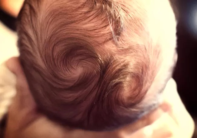 Xoáy tóc không ảnh hưởng đến sự phát triển trí não của trẻ