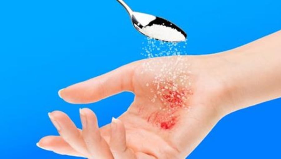 Rắc đường trắng lên vết loét trước khi băng có tác dụng tiêu diệt vi khuẩn ngăn cản quá trình hồi phục và gây ra cơn đau. (Ảnh minh họa)