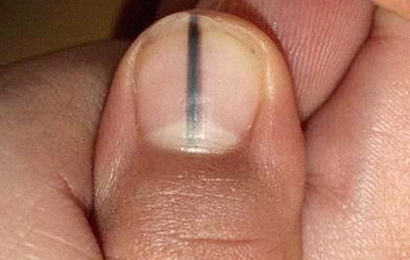  Đường sọc đen xuất hiện trên móng tay có thể là một biểu hiện của vấn đề gan và cần được xem xét một cách nghiêm túc.