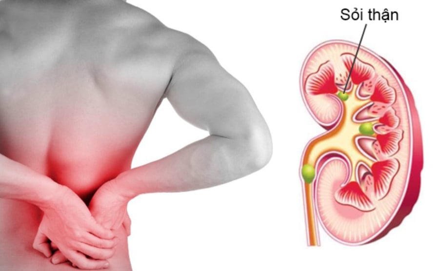 Những cơn đau dữ dội ở thắt lưng cũng có thể là một dấu hiệu của bệnh thận.