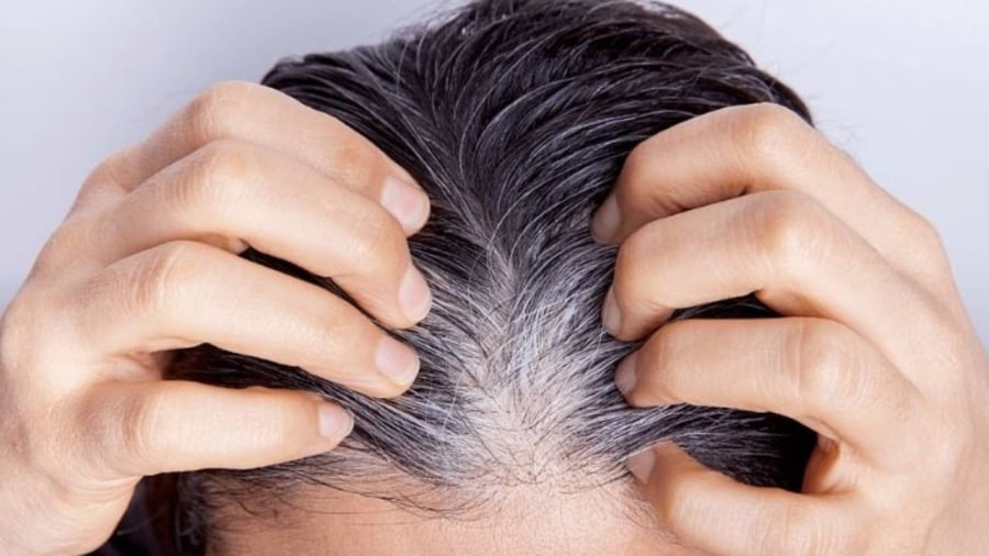 Nhiều nguyên nhân khiến tóc bạc sớm