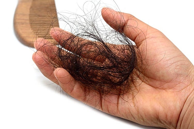 Nếu mỗi ngày có hơn 100 sợi tóc rụng là bệnh lý. Nếu vượt quá 100 sợi tóc, kéo dài từ 2 đến 3 tháng thì bạn nên đi khám. 