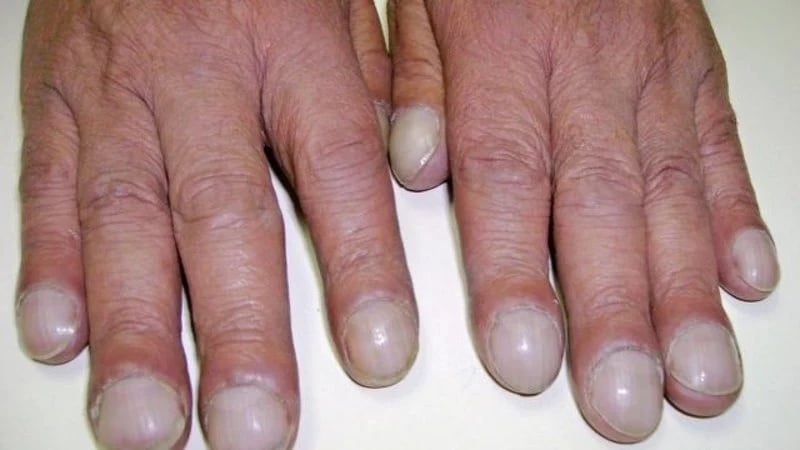 Ngón tay dạng dùi trṓng ᵭược nhận diện bởi ᵭầu ngón tay to hơn bình thường, móng tay có thể cong và phần da xung quanh trở nên sáng bóng