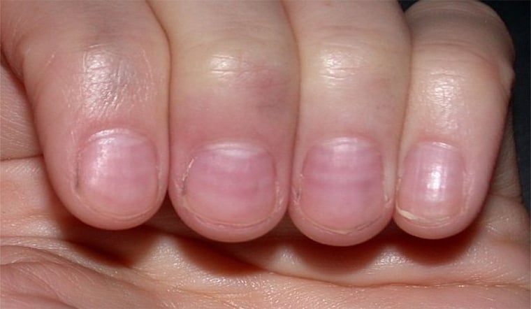 Một sṓ dấu hiệu ít ᵭược chú ý trên ngón tay có thể ʟà chỉ báo của 3 căn bệnh nguy hiểm
