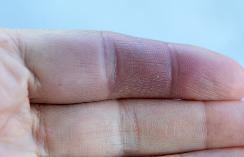 Sự xuất hiện của vết bầm tím trên ngón tay là hiện tượng hiếm gặp và có thể liên quan đến các vấn đề về máu