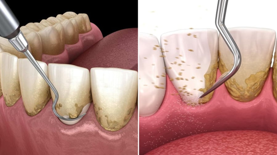 Vệ sinh răng miệng thường xuyên là một cách đơn giản để ngăn ngừa hình thành cao răng.