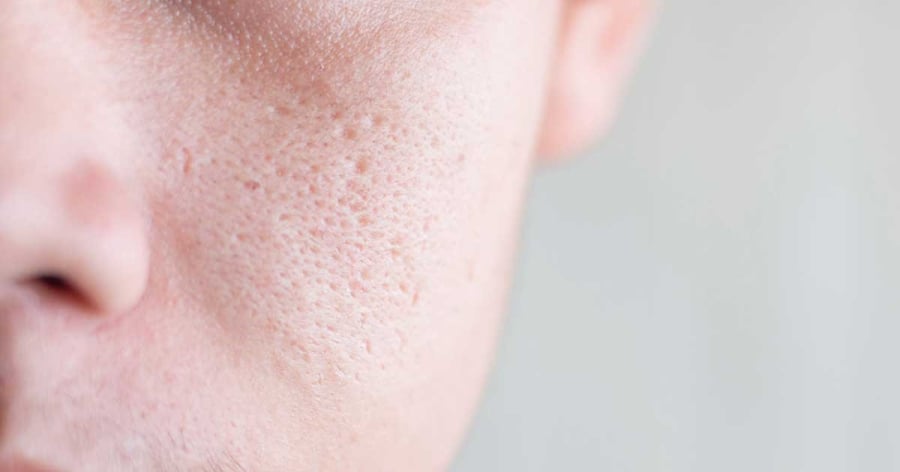 Sẹo rỗ (sẹo lõm) là di chứng của các tổn thương trên da
