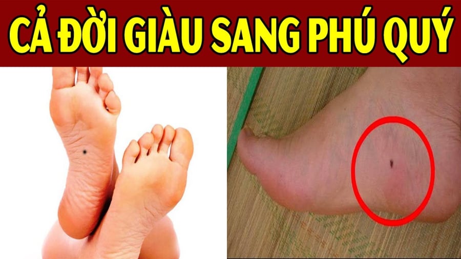 Nốt ruồi phú quý tài lộc