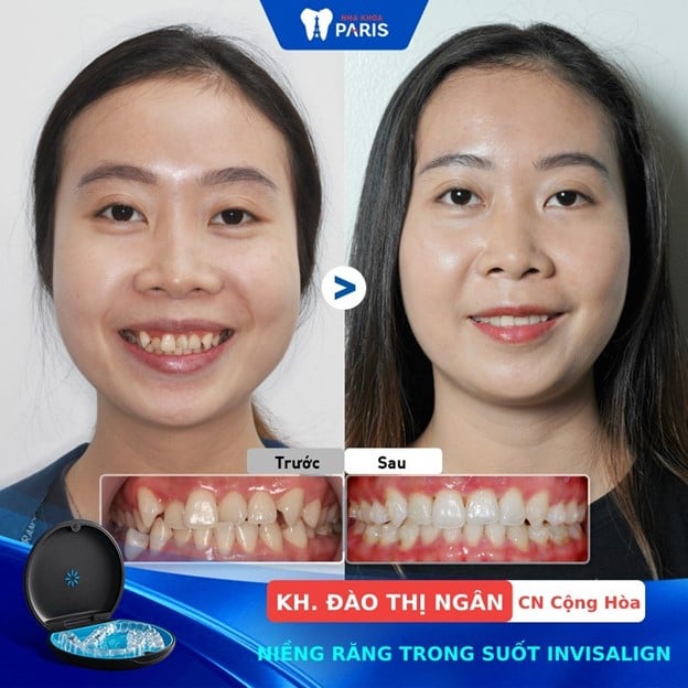 Khách hàng sau khi niềng răng trong suốt Invisalign tại Nha Khoa Paris