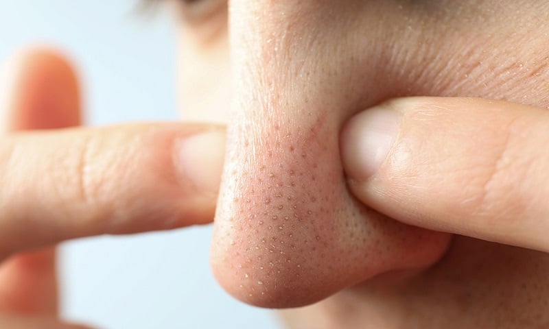 image of blackheads