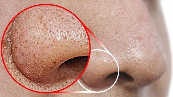 image of person with blackheads