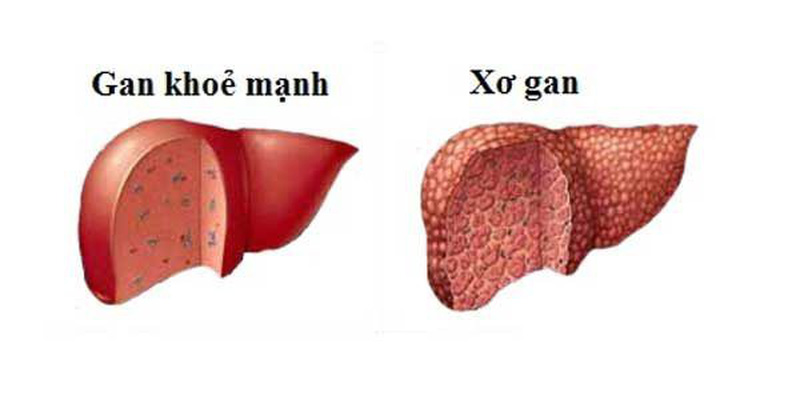 Gan có thể gặp nhiều vấn đề khác nhau, trong đó xơ gan là một trong những tình trạng nghiêm trọng nhất