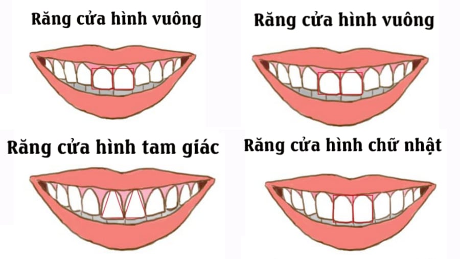 Theo nhân tướng học, mỗi dáng răng cửa có thể tiết lộ một số đặc điểm về tính cách, vận số của một người.