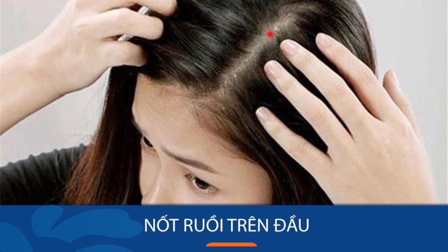 Nốt ruồi trên đỉnh đầu