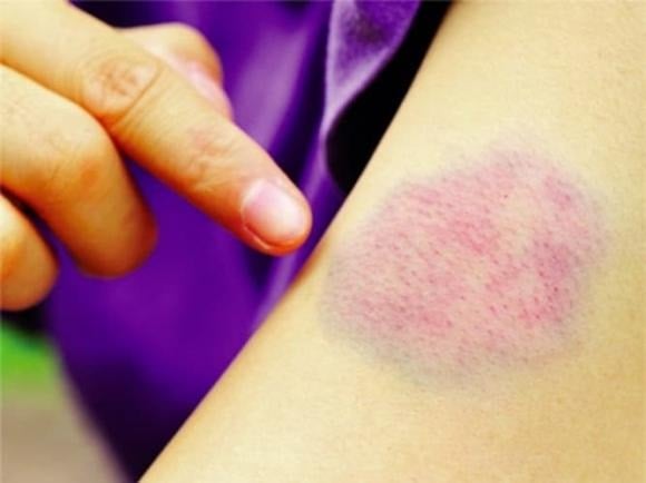 Làm suy giảm chức năng đông máu, dẫn đến tình trạng bầm tím dễ xuất hiện ngay cả khi không có va chạm mạnh.