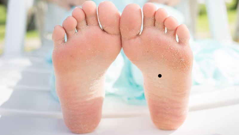Người dưới lòng bàn chân có nốt ruồi đen. (Ảnh minh họa)