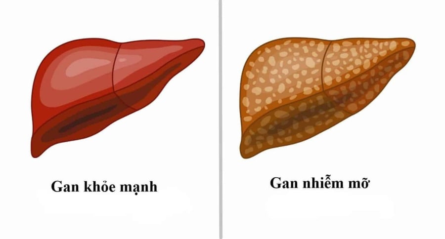 Không dừng lại ở đó, gan nhiễm mỡ còn làm tăng nguy cơ mắc ung thư đại tràng gấp 20 lần, đồng thời liên quan đến nhiều bệnh lý ngoài gan như: tim mạch, thận mạn tính, hội chứng ngưng thở khi ngủ…    