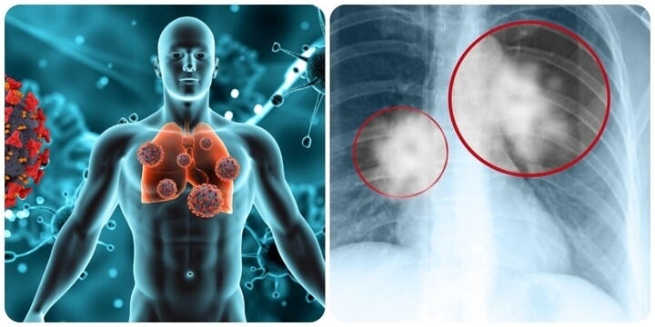 Việc phát hiện ung thư phổi ở giai đoạn sớm (giai đoạn I, khi khối u còn nhỏ hơn 4cm và chưa di căn) có thể giúp nâng tỷ lệ sống thêm 5 năm lên đến 90%.