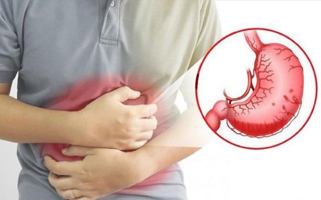 Những biểu hiện của bệnh dạ dày