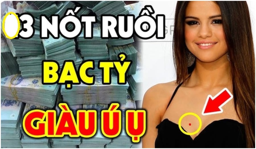 Nốt ruồi tựa hố chôn tiền may mắn 