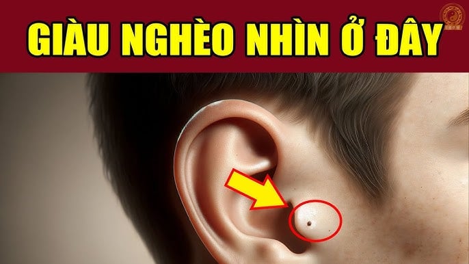 Nốt ruồi may mắn