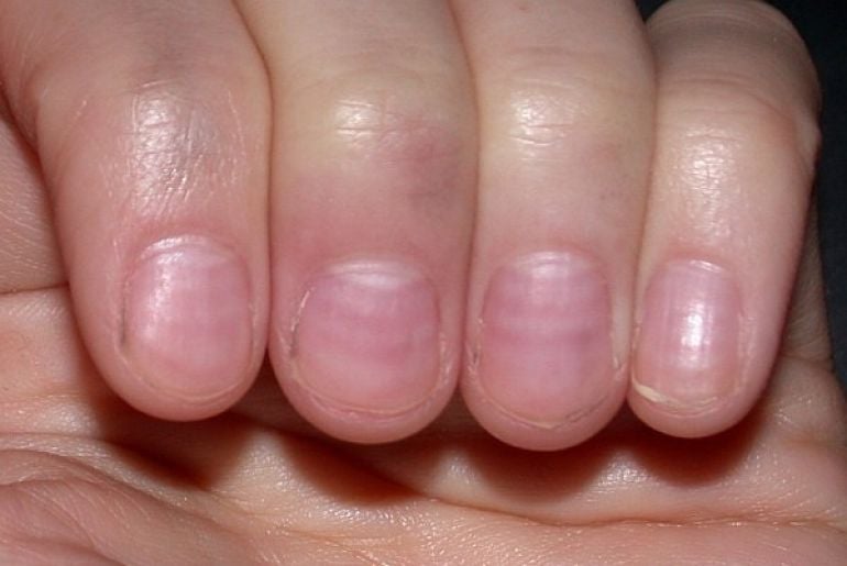 Nhìn móng tay bắt bệnh