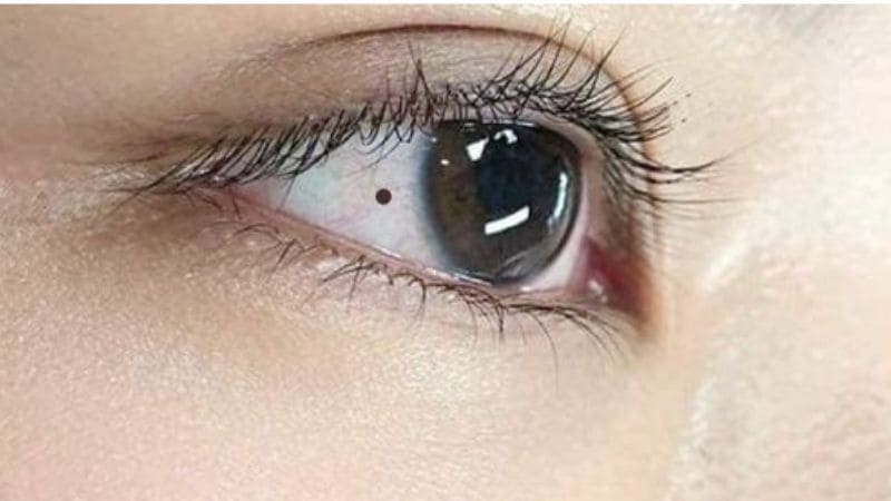 Giải mã tính cách và vận mệnh qua nốt ruồi. (Ảnh minh họa)