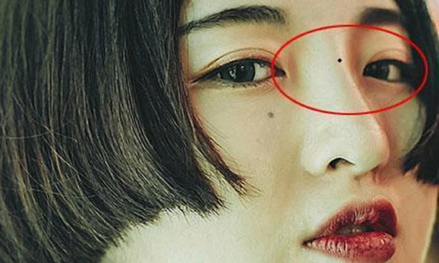 Nốt ruồi tán lộc
