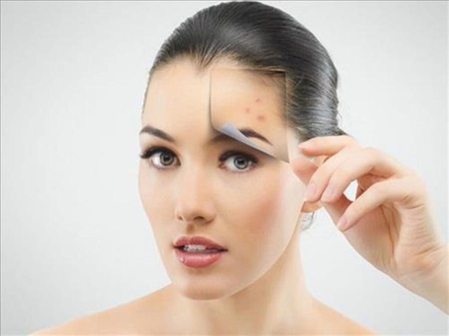 Trán xuất hiện nhiều mụn. (Ảnh minh họa)
