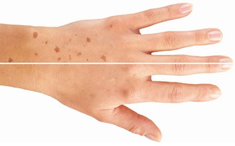 Nếu bạn nhận thấy sự xuất hiện của những đốm sắc tố bất thường — như đồi mồi, nám, vùng da sạm màu không đều — hãy lưu ý