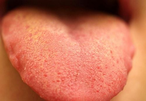 Những biểu hiện ở lưỡi có liên quan tới sức khỏe