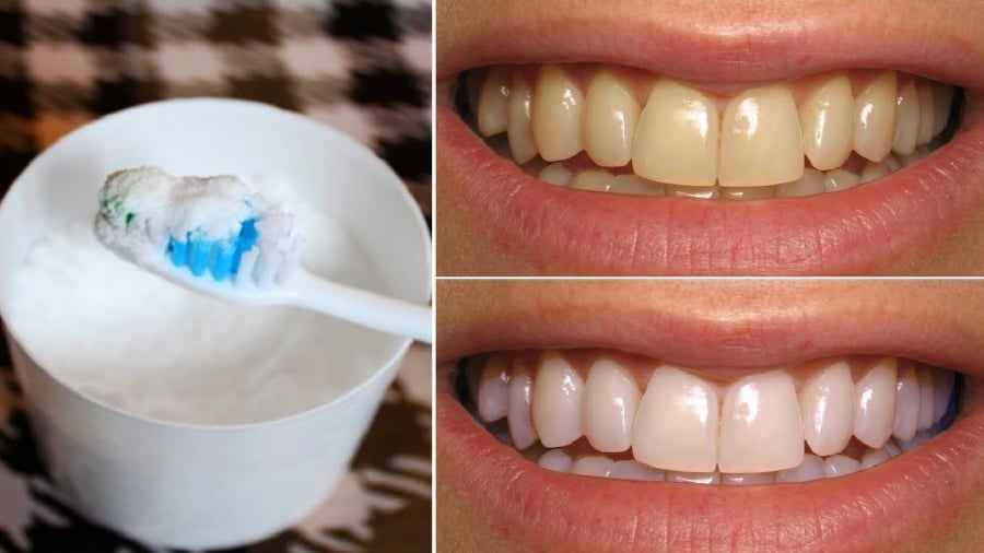 Bạn có thể sử dụng baking soda để làm sạch mảng bám và làm trắng răng.