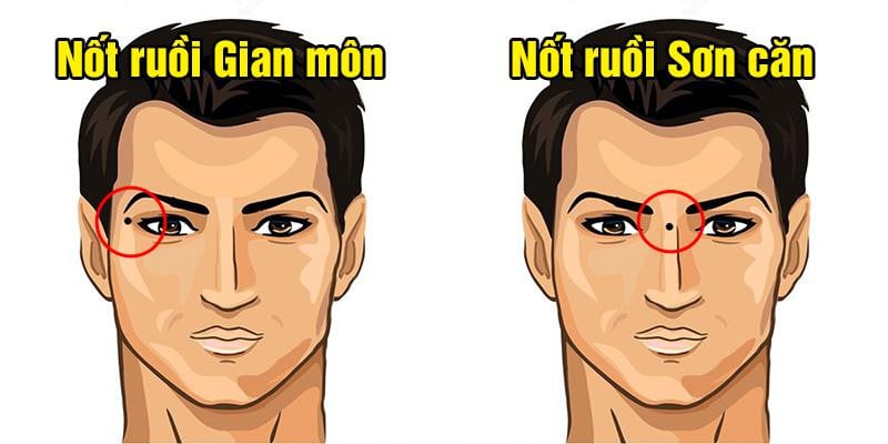 Nốt ruồi tán lộc