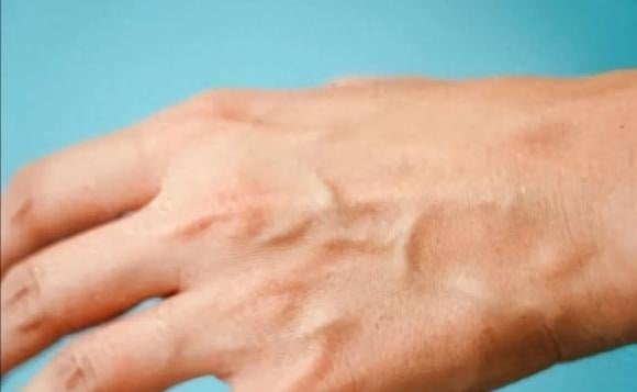 Ở người trẻ, da còn săn chắc, có khả năng giữ các tĩnh mạch ổn định.