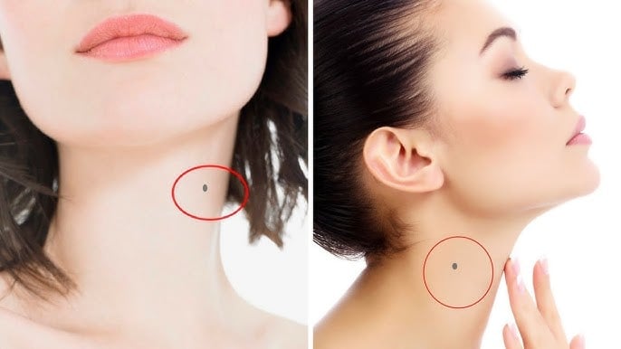 5 Nốt ruồi Mở Vận, ai có 1/5 thật đáng chúc mừng