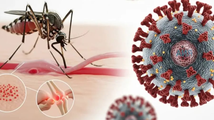 Chikungunya là bệnh do virus Chikungunya, được lây truyền qua muỗi Aedes.