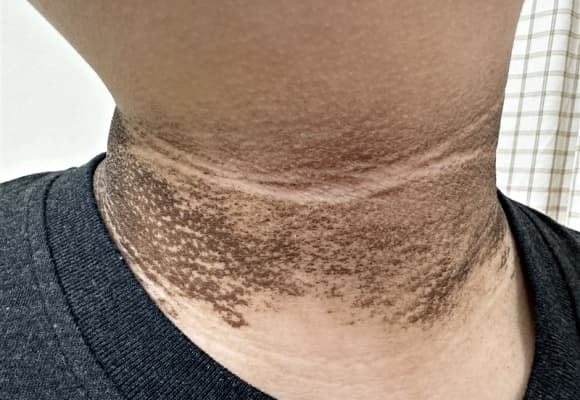 Các mảng da sẫm màu, dày và sần sùi xuất hiện ở các nếp gấp cổ thường được gọi là gai đen.