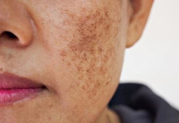 Da mặt trở nên tối, xỉn màu có thể do gan bị tổn thương từ bệnh gan mạn tính, xơ gan hoặc ung thư gan, khiến quá trình chuyển hóa melanin và bilirubin rối loạn, làm sắc tố da tích tụ.