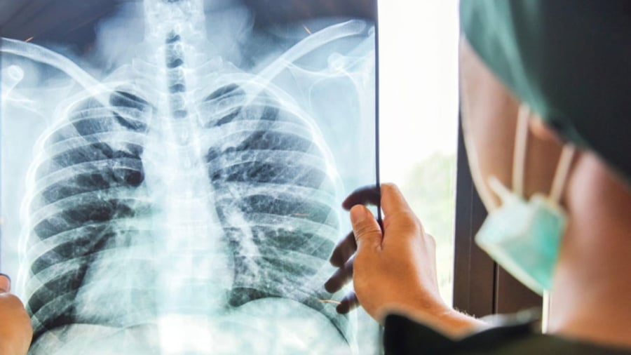 Chị T. bị đau lưng và ho kéo dài. Đến lúc đi khám, bác sĩ chẩn đoán chị bị K phổi giai đoạn cuối, di căn xương. (Ảnh minh họa)