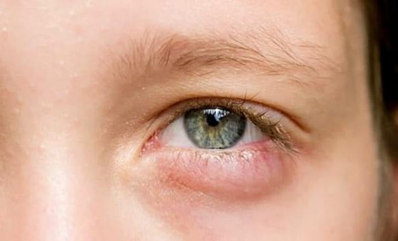 Trong khi bọng mắt sưng do ngủ sai tư thế hoặc uống nhiều nước vào buổi tối là hiện tượng bình thường, tình trạng sưng phù kéo dài kèm sắc tố đậm màu hơn lại là dấu hiệu cảnh báo.    