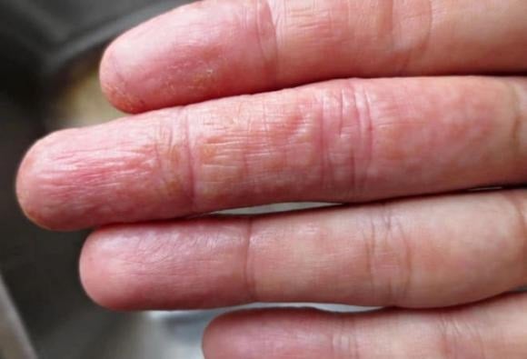 Không ít người cho rằng mụn nước ở ngón tay chỉ đơn giản là do dị ứng và thường xử lý bằng thuốc bôi ngoài da.