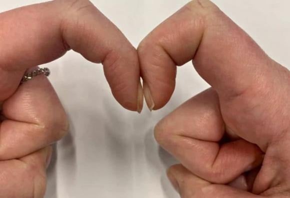 Thống kê cho thấy khoảng 30% bệnh nhân ung thư phổi có dấu hiệu này.