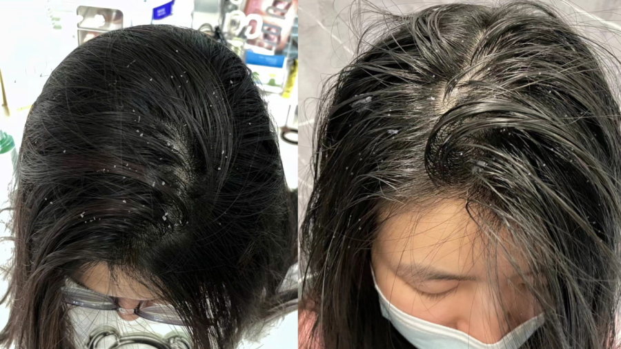 Gàu ngứa tăng sinh gây ngứa ngáy